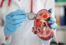 Cálculo renal causas sintomas danielhampl.com.br