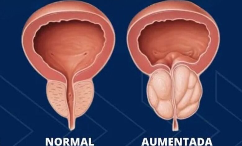 Hiperplasia prostática sintomas tratamentos danielhampl.com.br